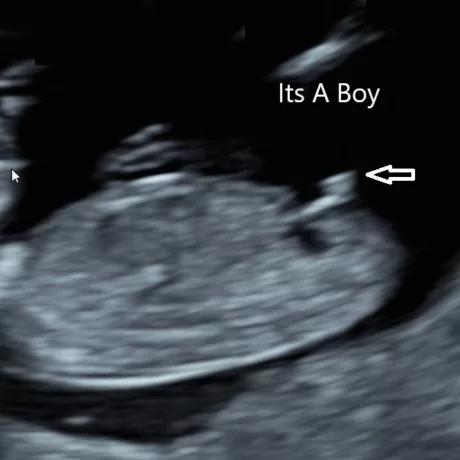 Boy Ultrasound