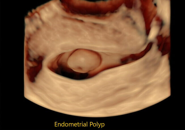 Sonohysterogram ultrasound